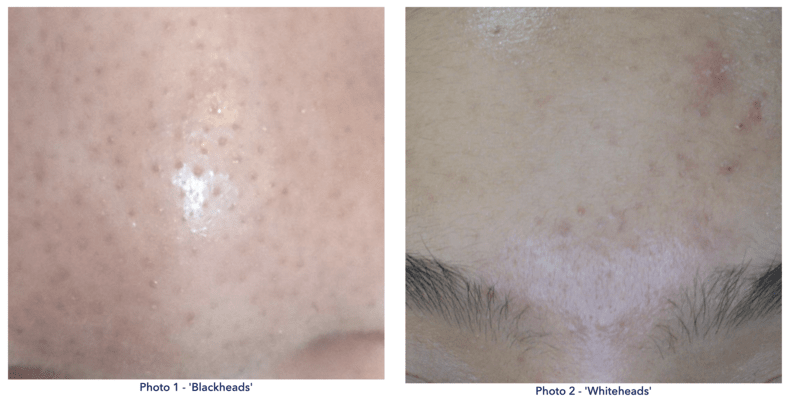 Screenshot of acne-related educational content on a digital interface