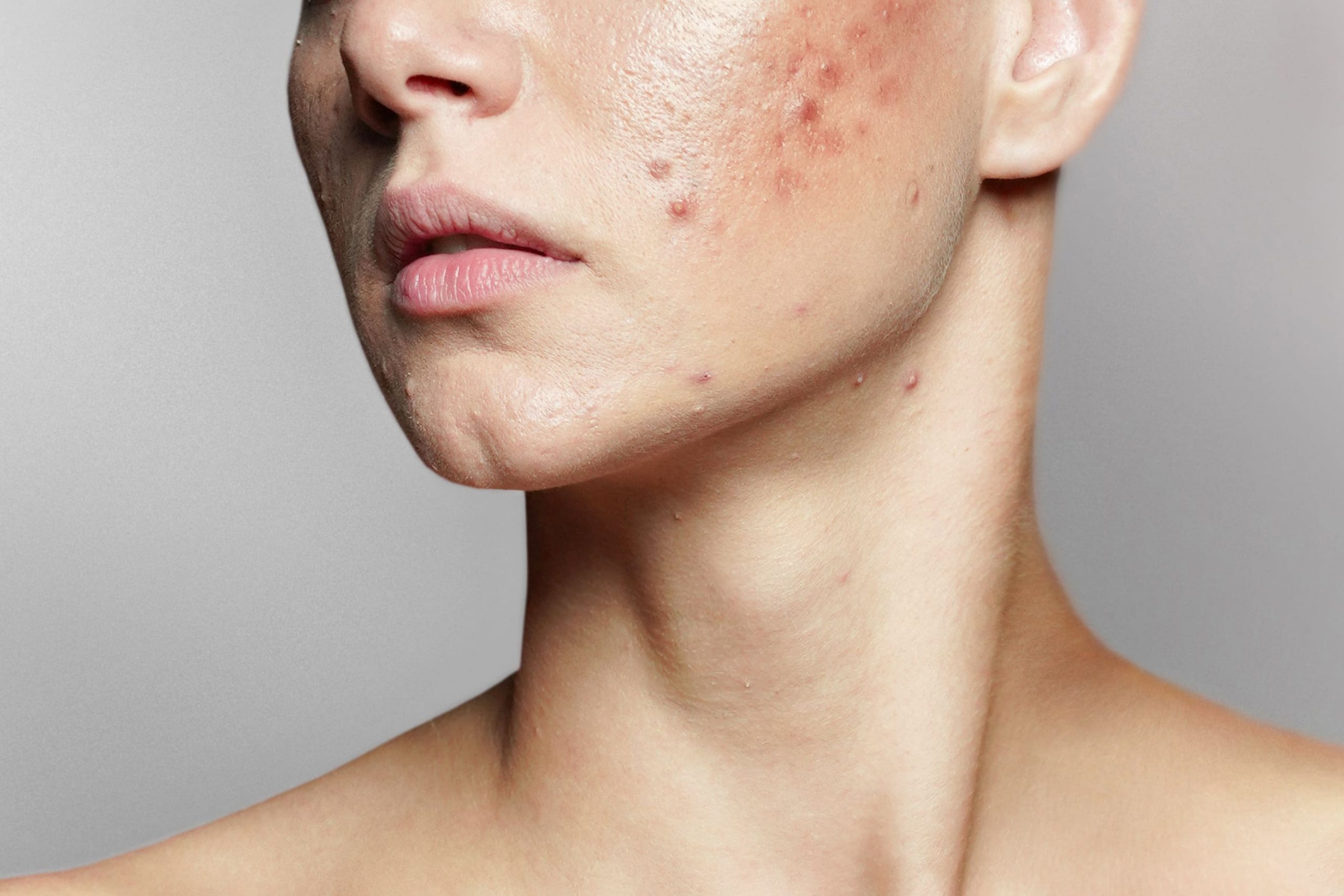 https://idsclinic.sgestaging.com/wp-content/uploads/2022/11/acne-hero-scaled.jpgAcne