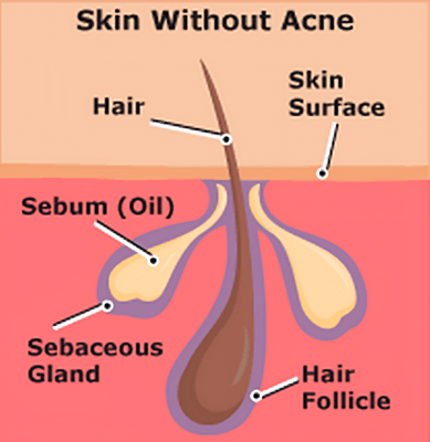 Illustration showing reduced appearance of active acne