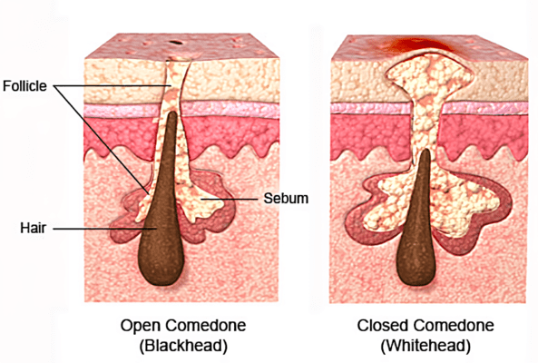 Illustration of acne-prone skin at a different stage of condition