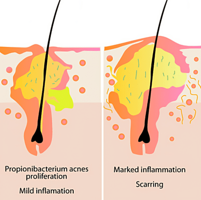 Illustration showing gradual changes in acne-prone skin condition