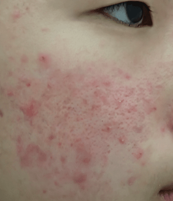Illustration showing smoothing of acne-affected skin surface