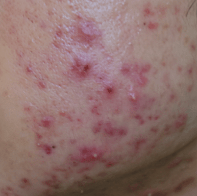 Close-up illustration of acne-prone facial skin texture