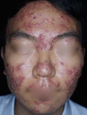Close-up illustration of inflamed acne lesions on skin
