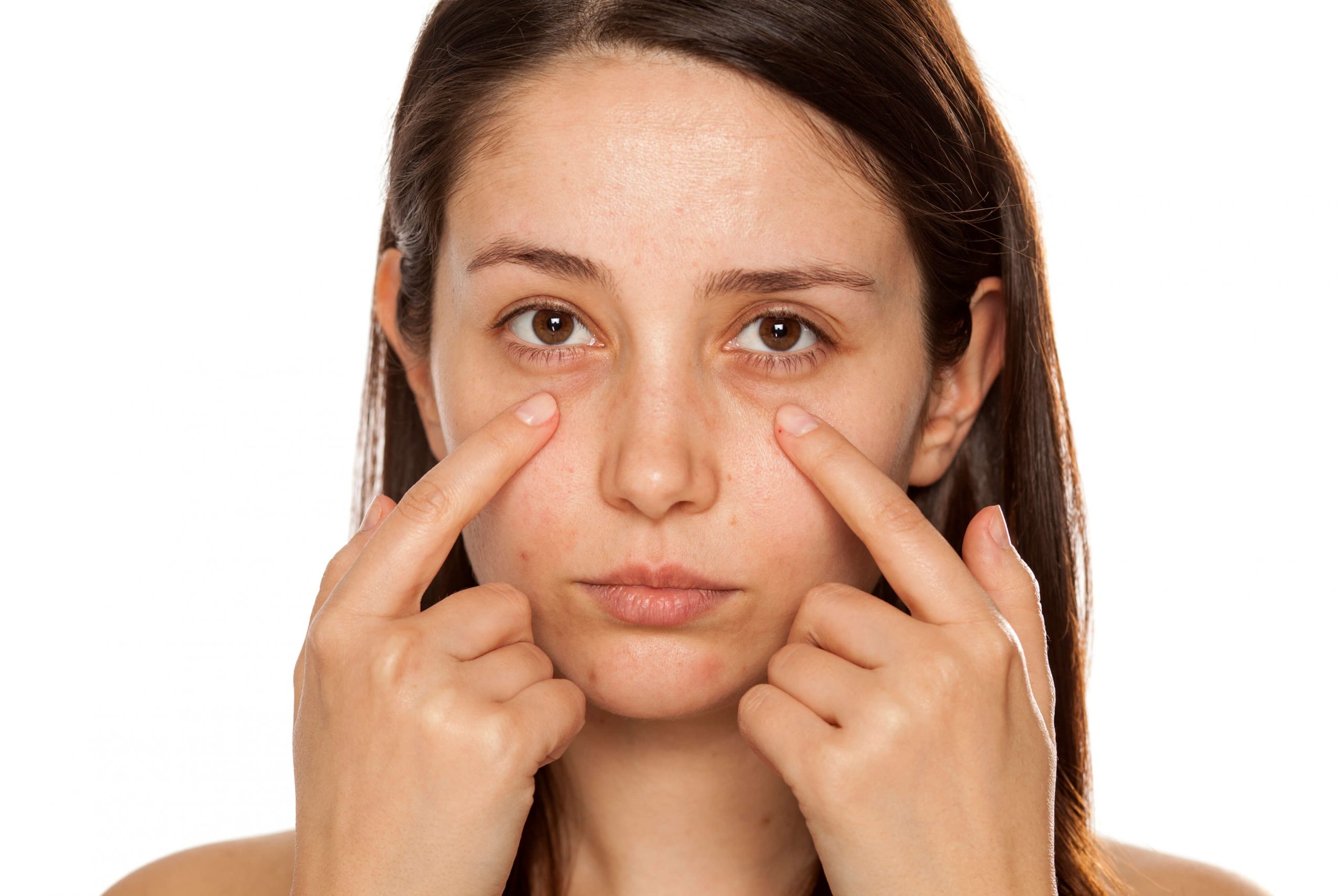 Hero image showing puffiness and shadows under the eyes