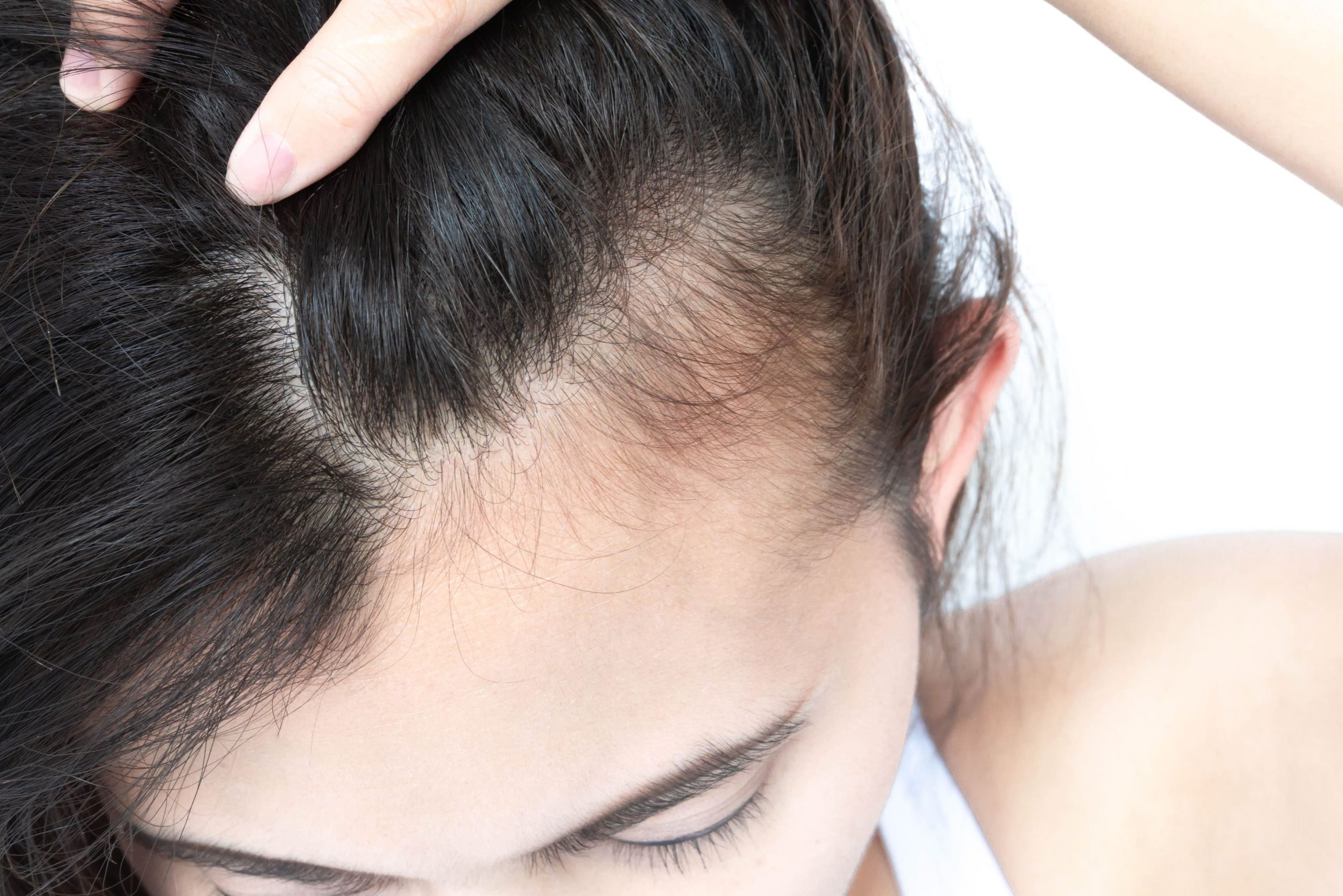 Diagram showing different patterns of hair loss