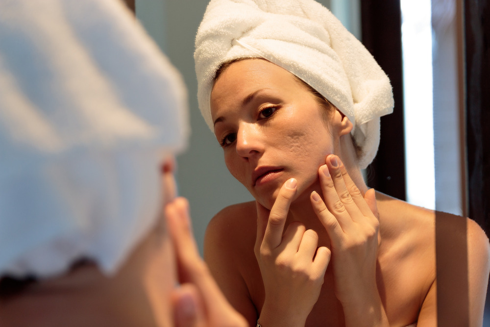 https://idsclinic.sgestaging.com/wp-content/uploads/2022/11/iStock-1142670146-1.jpgAcne Scars