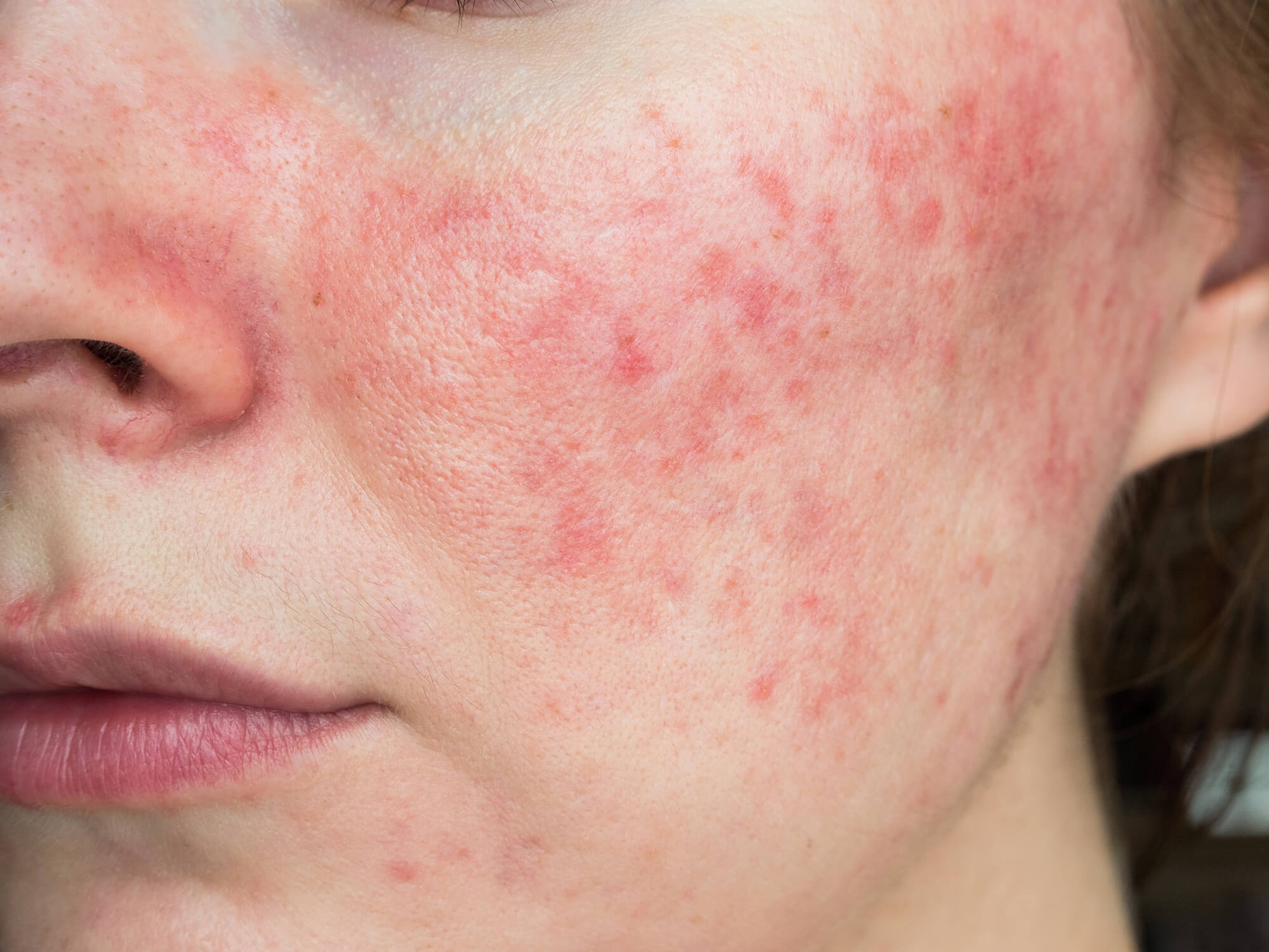 https://idsclinic.sgestaging.com/wp-content/uploads/2022/11/rosacea-hero-img.jpgRosacea