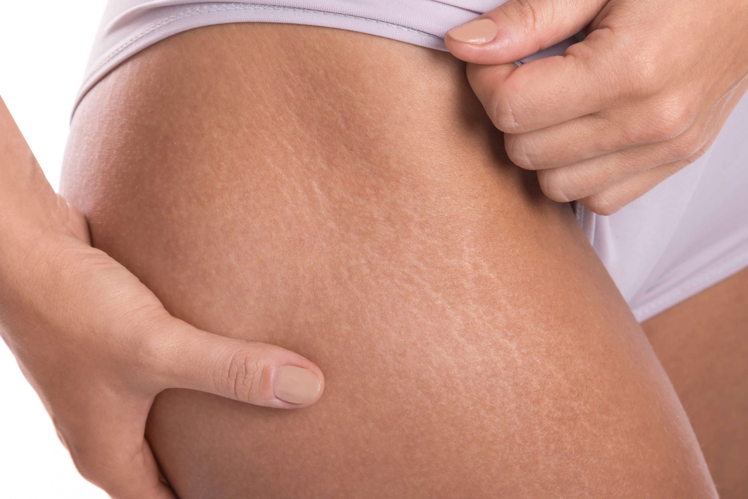 https://idsclinic.sgestaging.com/wp-content/uploads/2022/11/stretch-marks-hero-img-scaled.jpgStretch Marks