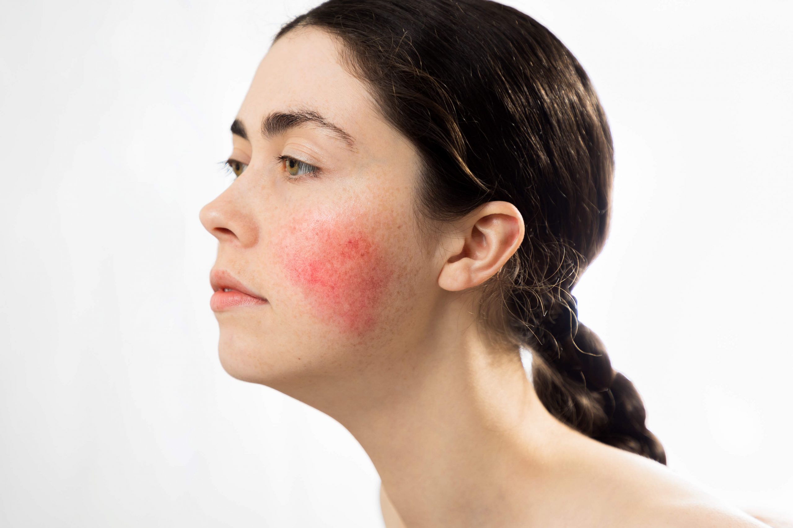 Diagram illustrating different recognised types of rosacea