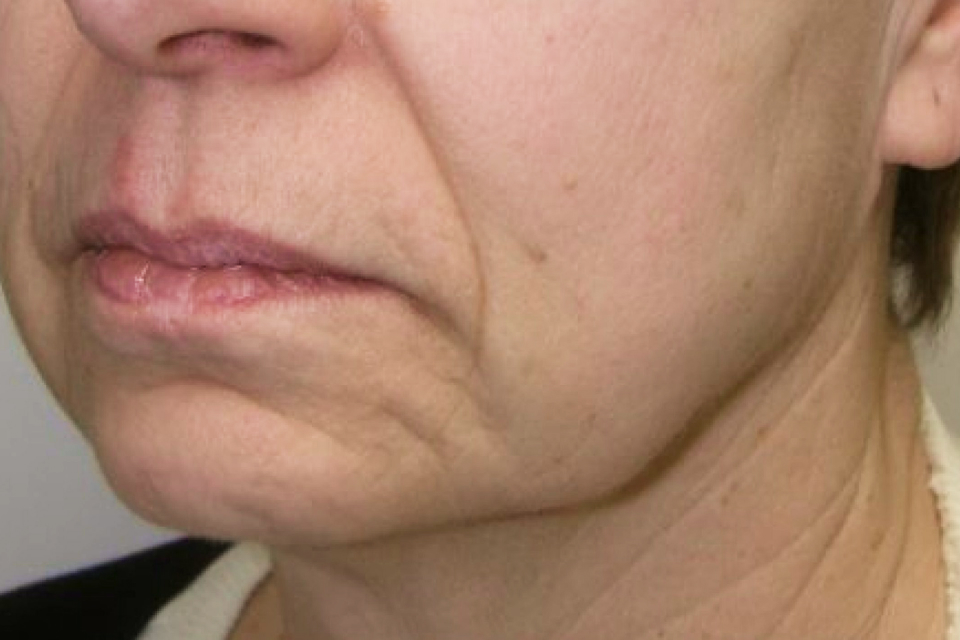 Illustration showing mid-face skin laxity pattern