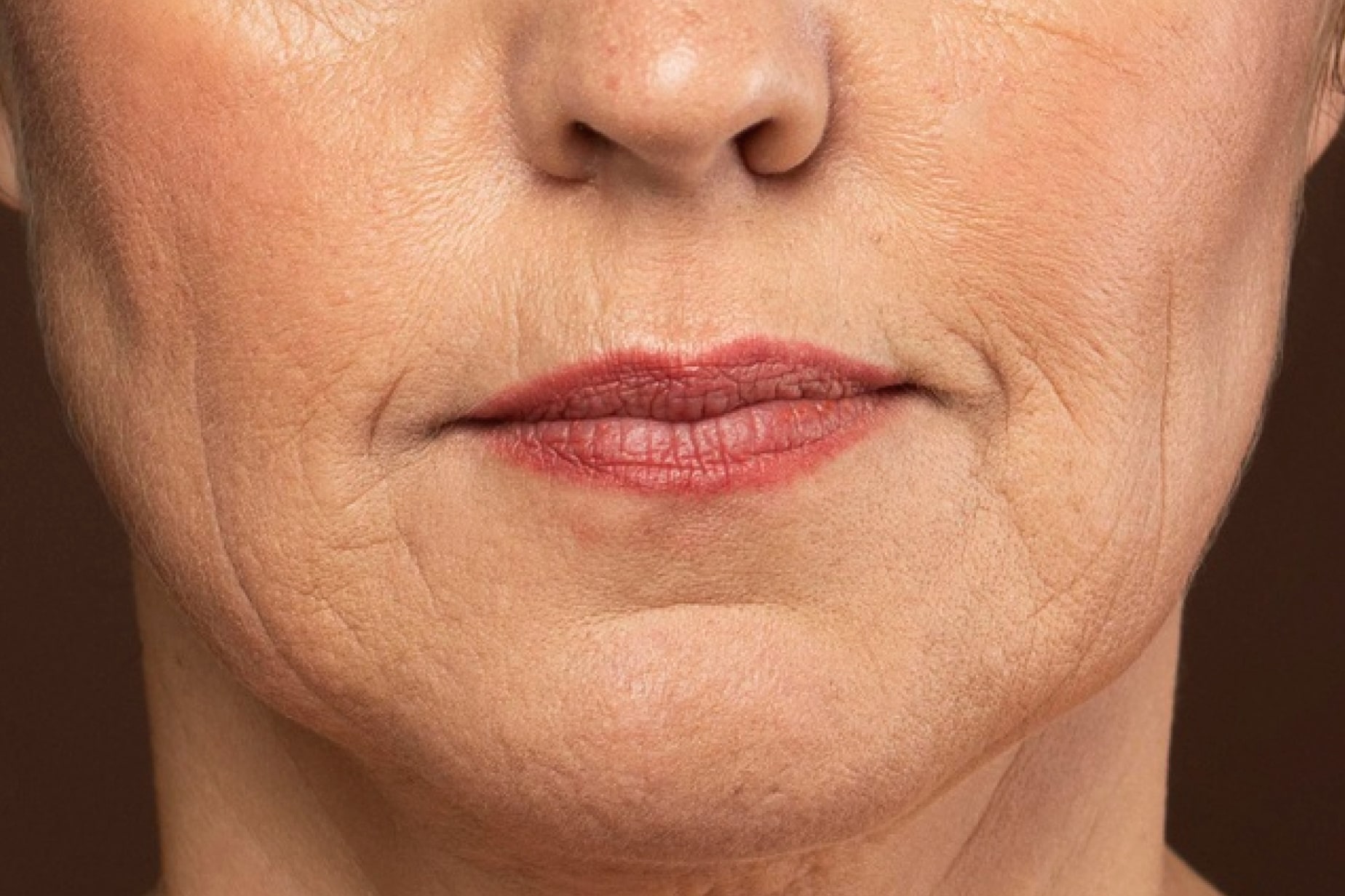 Illustration showing advanced facial sagging pattern