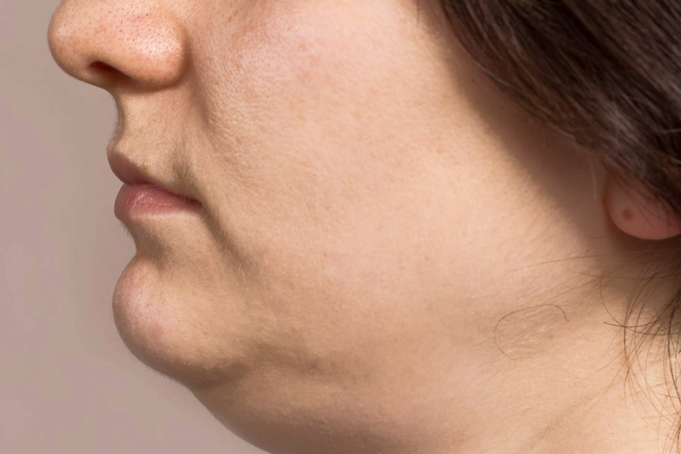 Illustration showing lower-face skin sagging pattern
