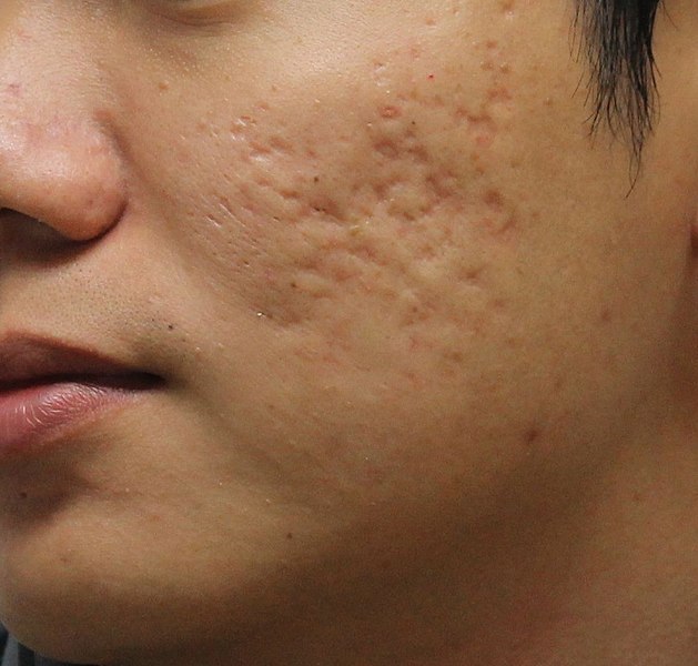Illustration showing boxcar-type acne scarring texture on the skin