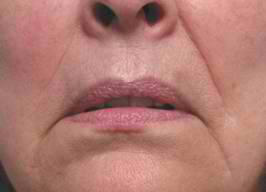 Illustration showing downturned corners of the mouth