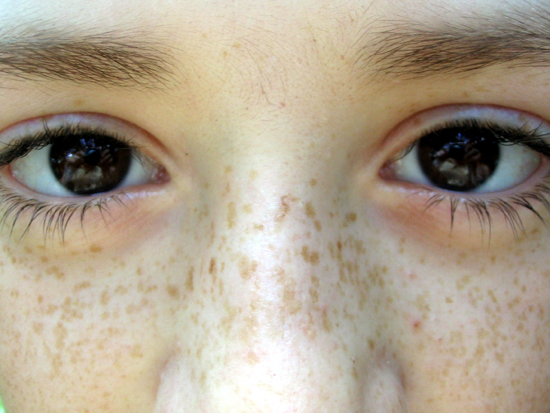 Illustration showing freckles on facial skin surface