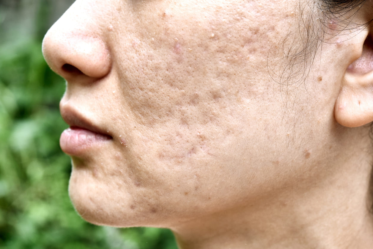 Close-up of an asian woman with acne scars on her face