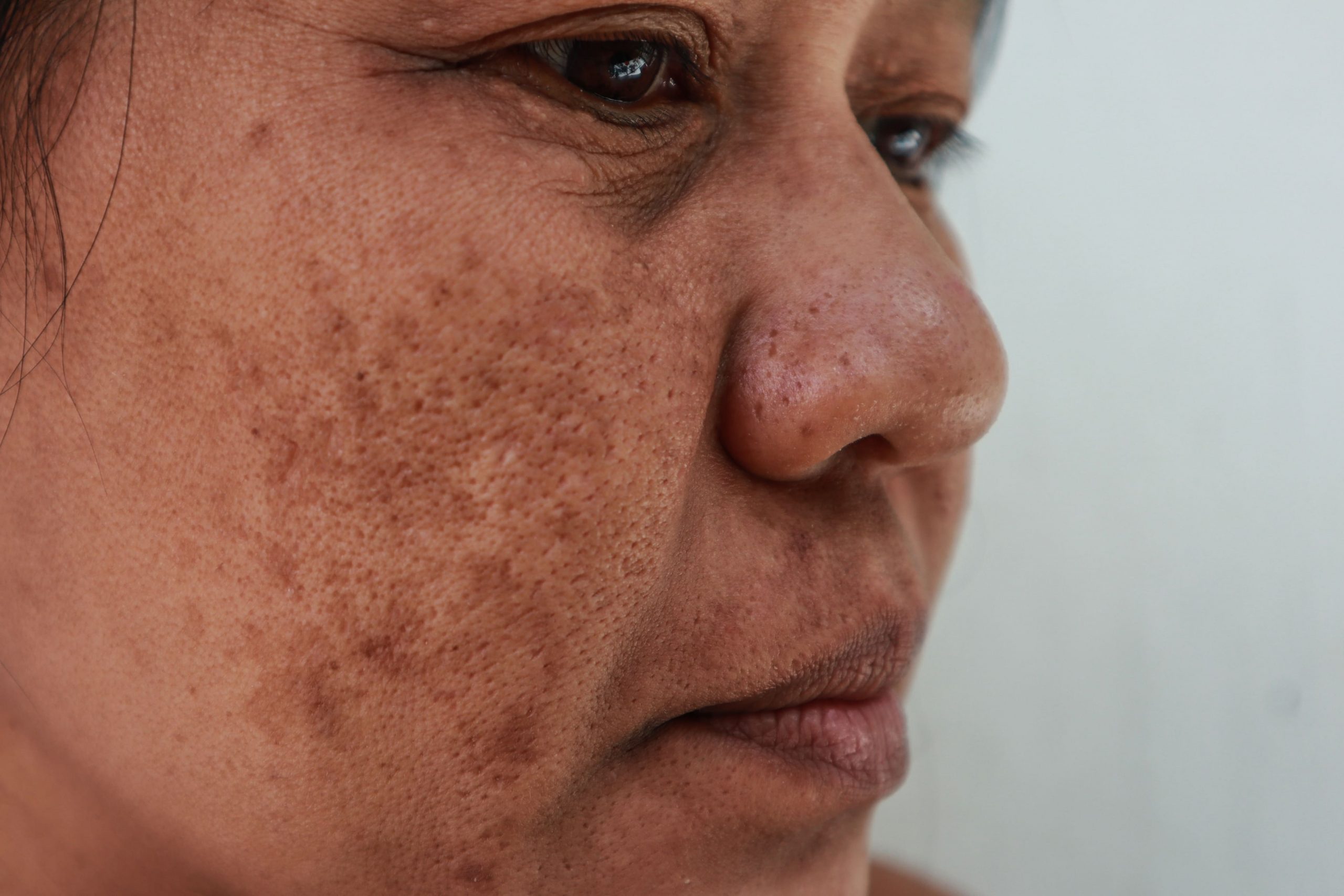 portrait of middle-aged asian woman with melasma