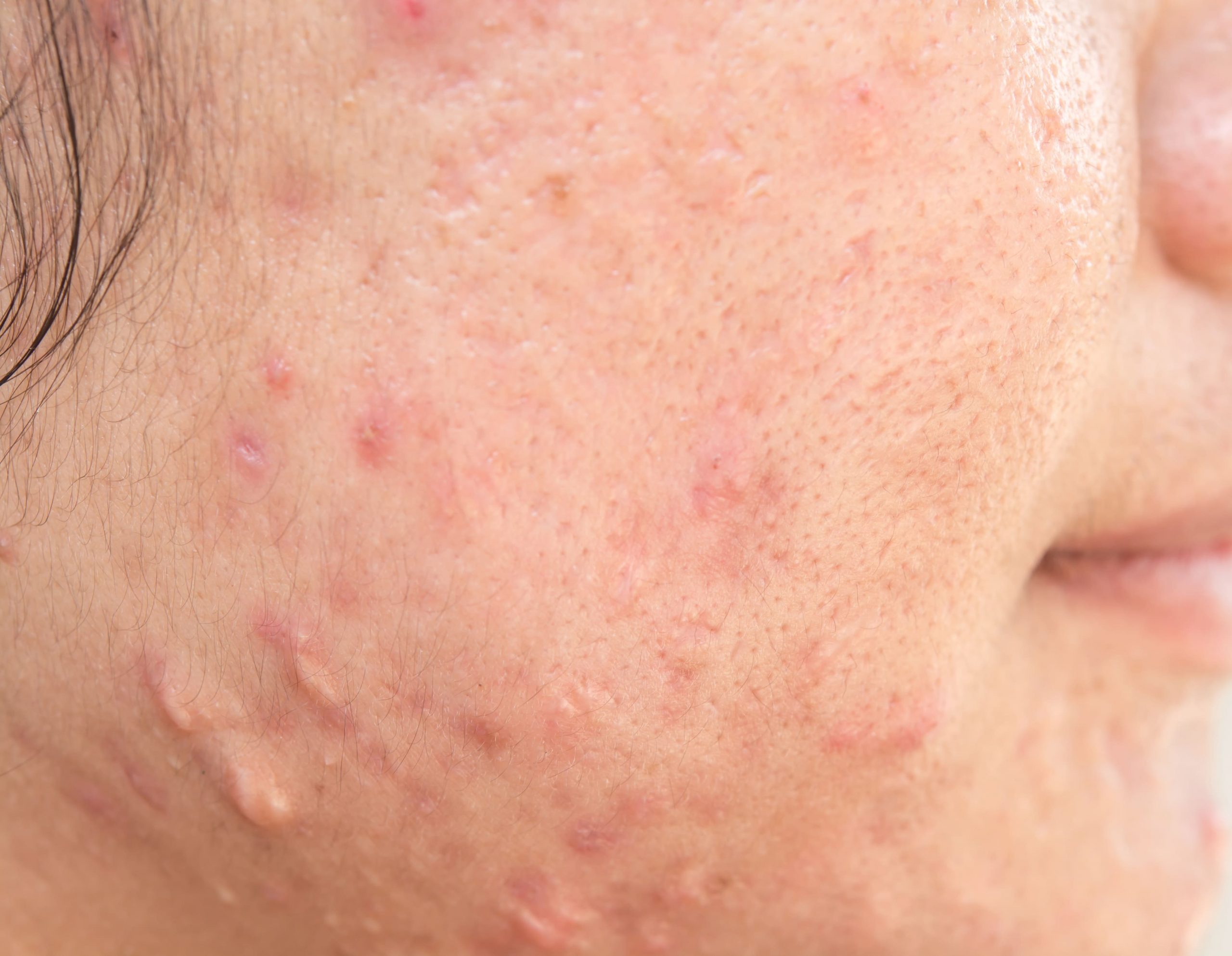 Close-up view of an asian woman's cheek showing active acne spots, redness, and uneven skin texture.