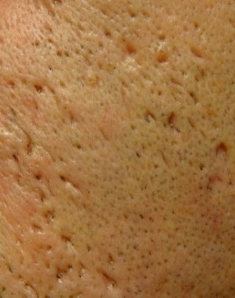 Illustration showing narrow and deep acne scar texture