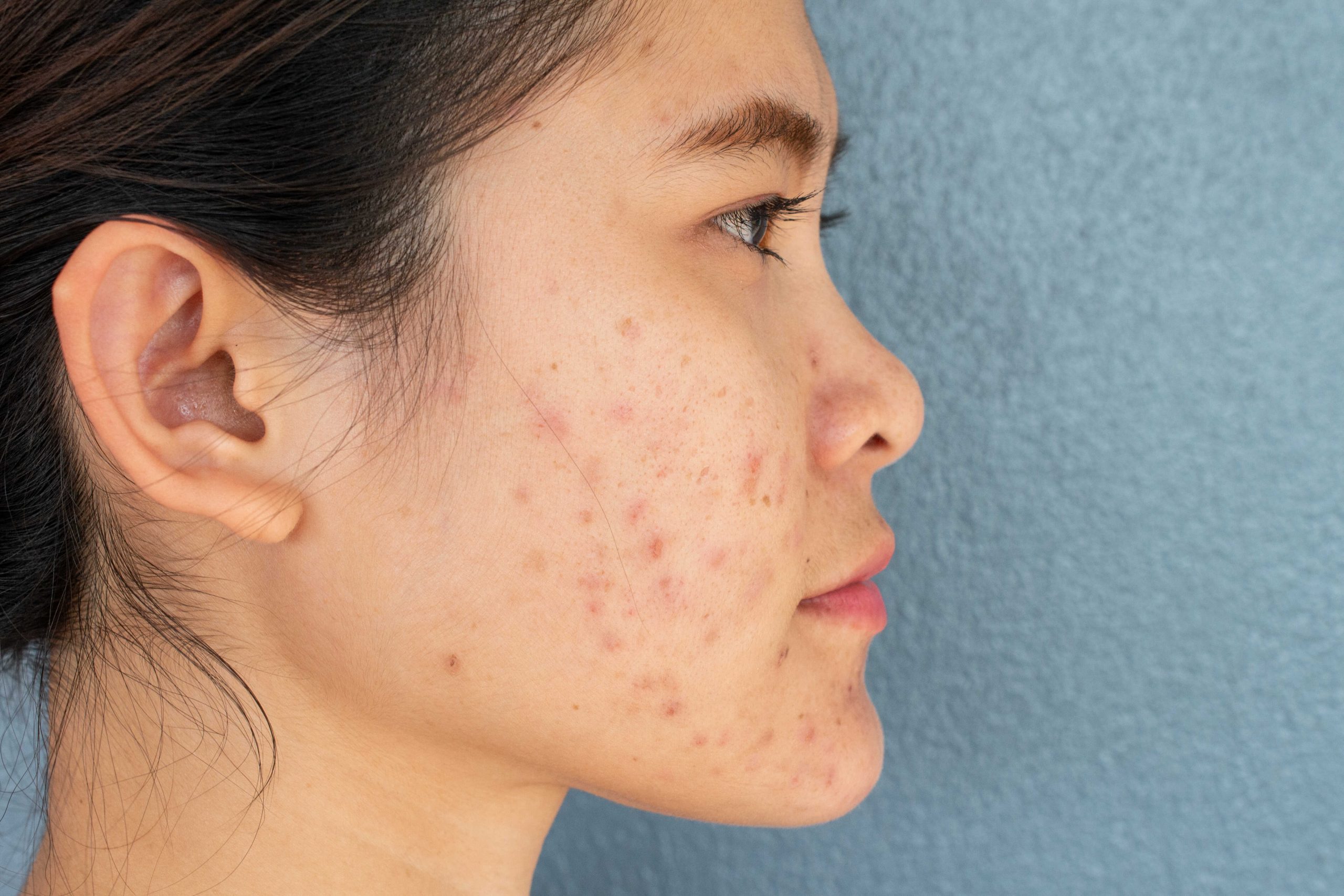 Close-up facial skin texture showing surface unevenness