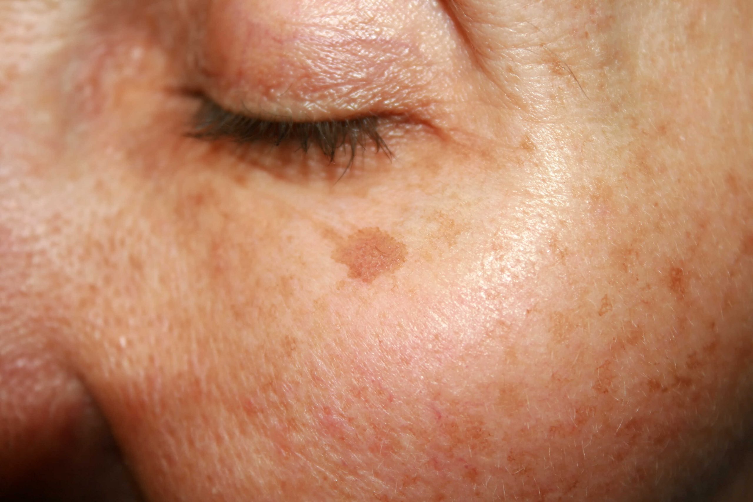 Illustration showing uneven facial pigmentation patterns