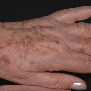 Illustration showing sun-induced pigmented skin spots