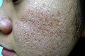Illustration showing mixed patterns of acne scarring on skin