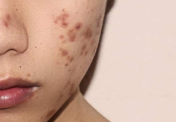 Illustration of post-inflammatory hyperpigmentation on skin