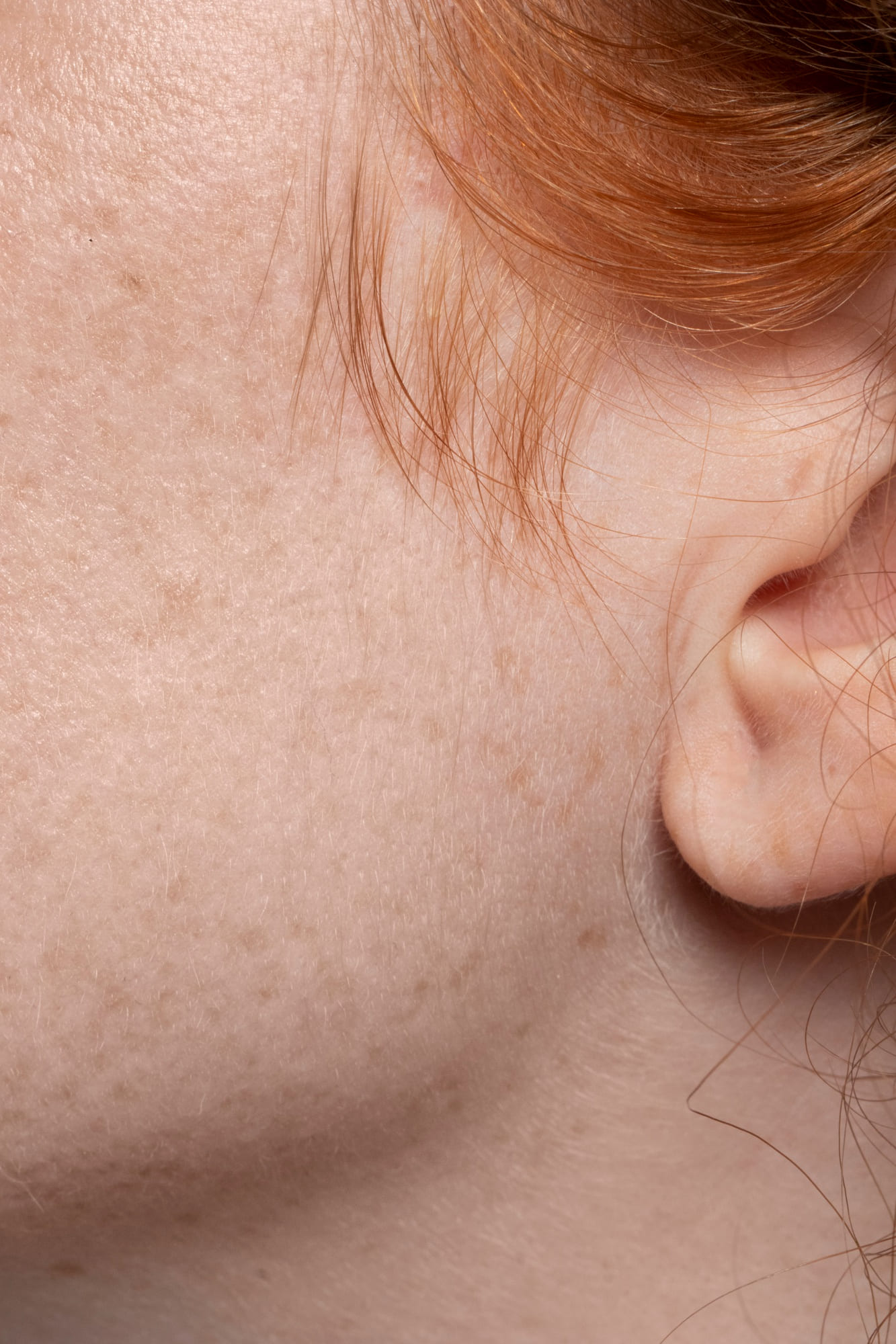 Illustration showing post-inflammatory skin discolouration from acne