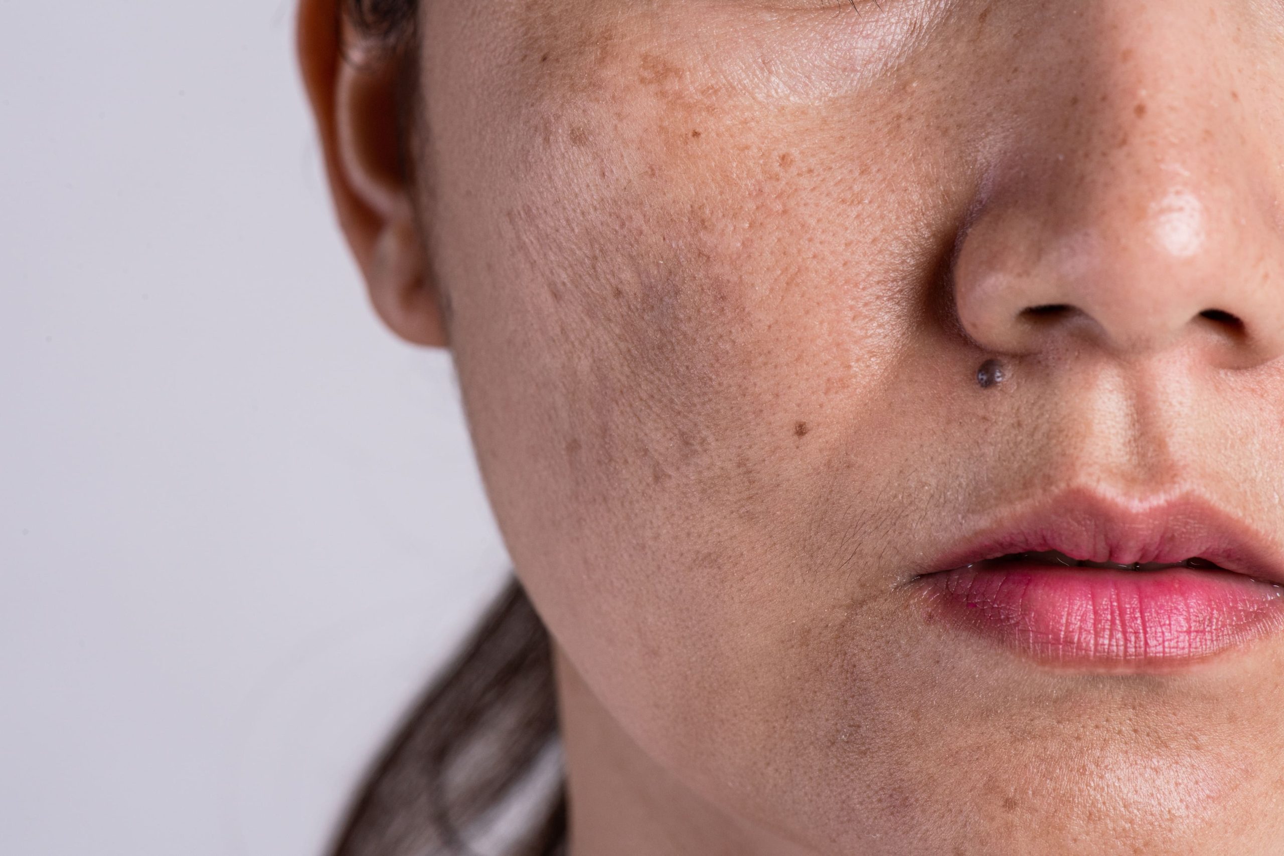 Blog feature image for pico laser and hyperpigmentation article