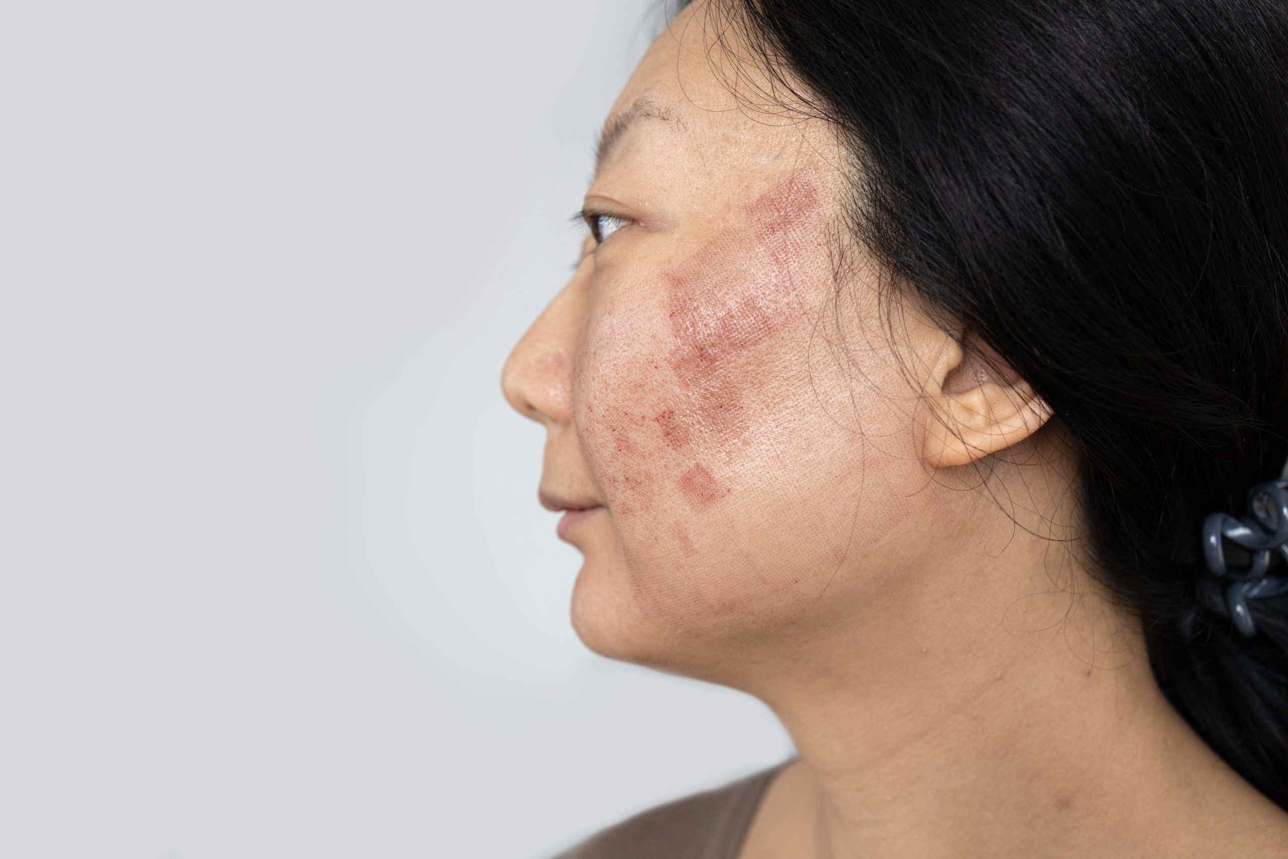 Side profile of a woman showing areas of facial redness and uneven skin tone on the cheek.