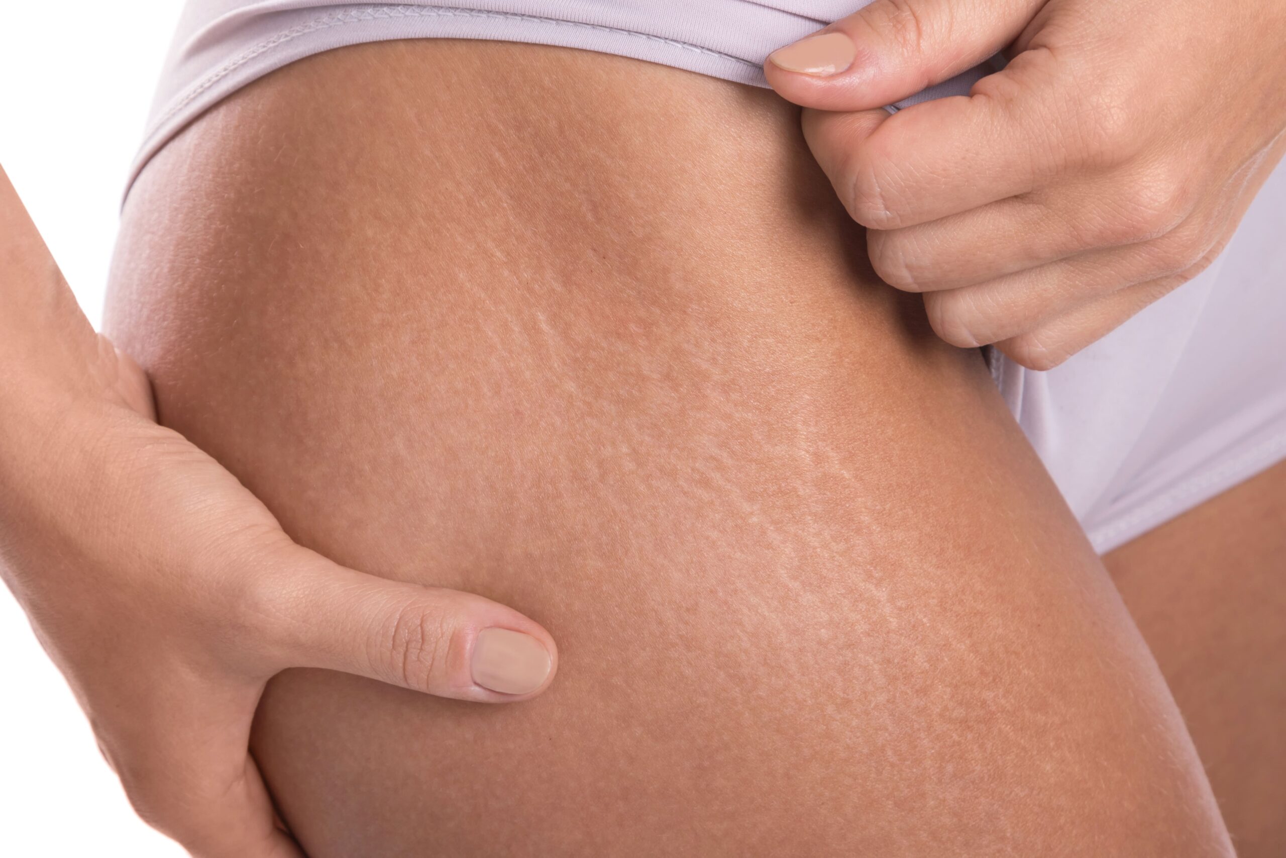 Illustration showing stretch marks on the upper thigh area