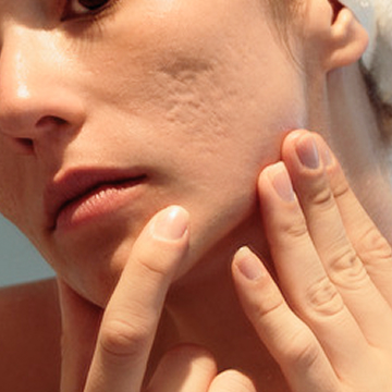 Illustration showing uneven skin texture caused by acne scarring