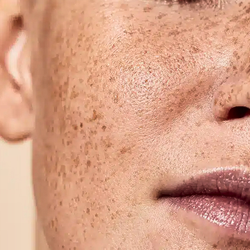 Illustration showing uneven skin tone and areas of hyperpigmentation