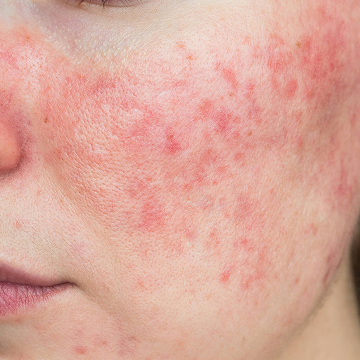 Illustration showing facial redness commonly associated with rosacea-prone skin