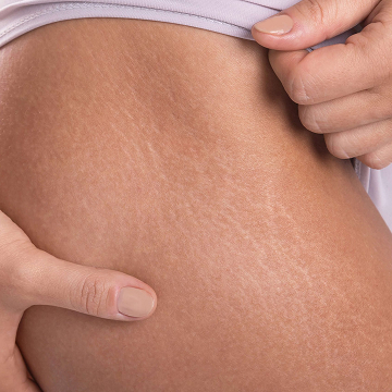 Illustration showing stretch marks on body skin texture