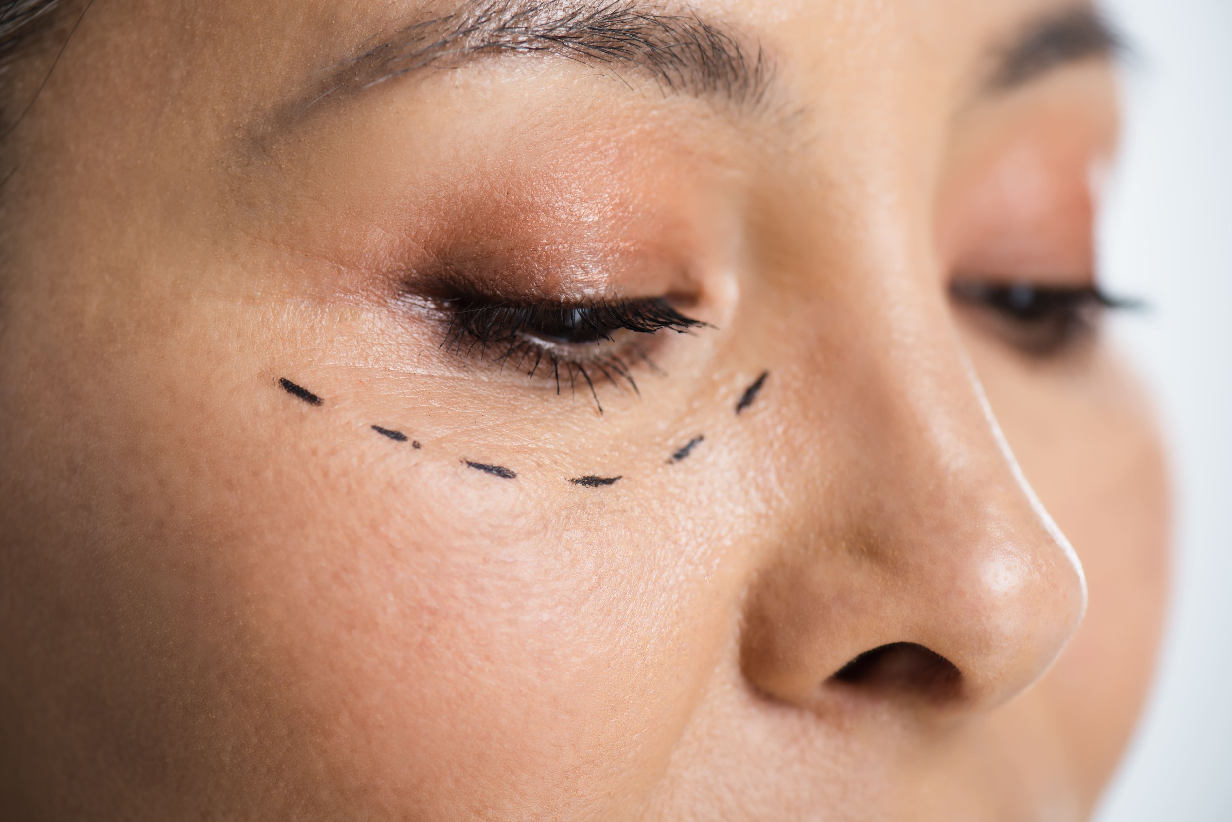 https://idsclinic.sgestaging.com/wp-content/uploads/2025/10/eyebag-removal.jpgEyebag Removal