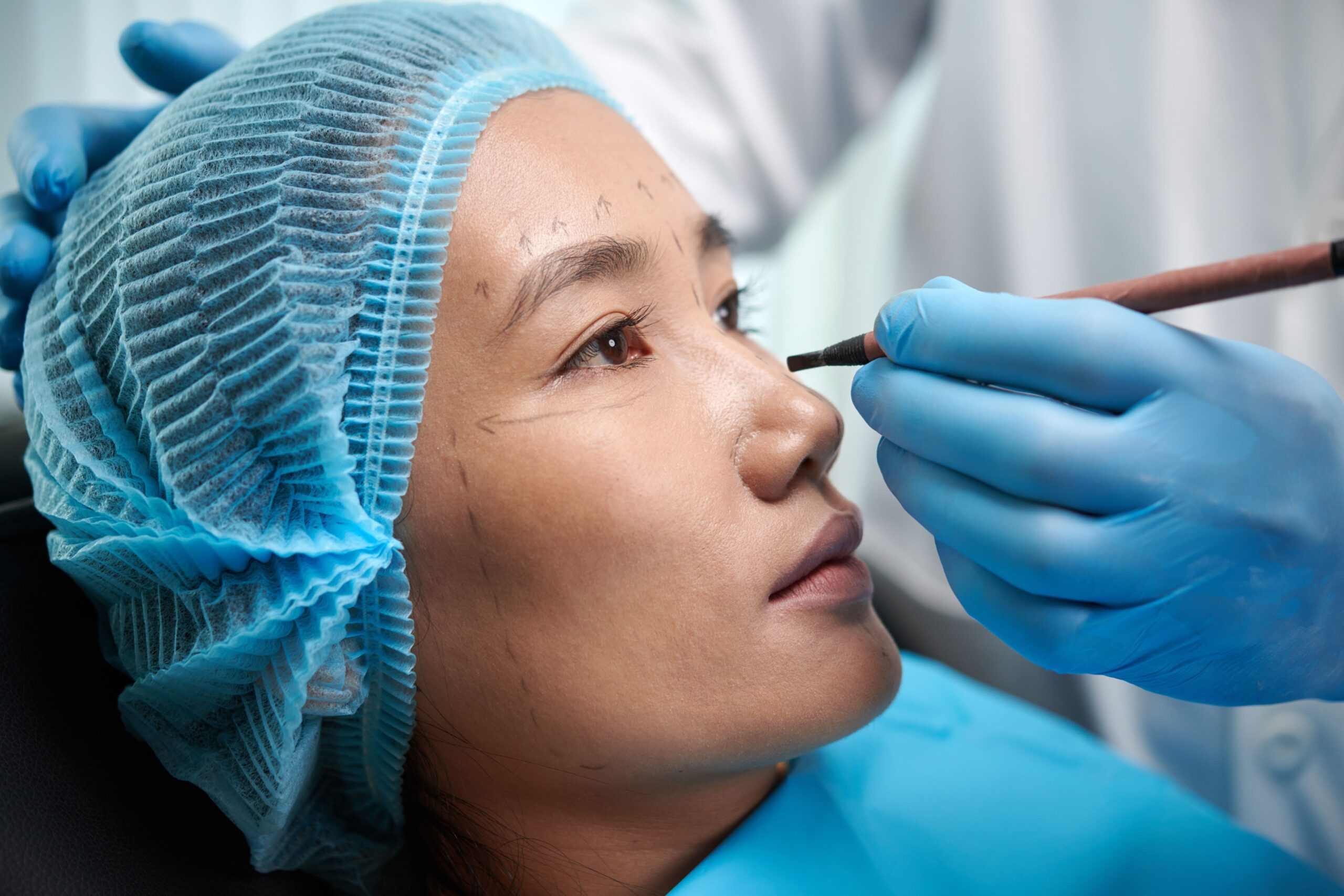 https://idsclinic.sgestaging.com/wp-content/uploads/2025/10/surgeon-drawing-lines-on-face-2025-01-29-08-02-52-utc-scaled.jpgDark Eye Circles Treatment in Singapore