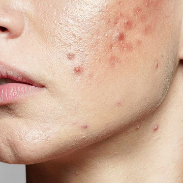 Acne img