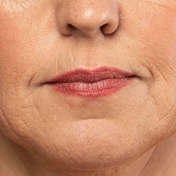 Lines Wrinkles img
