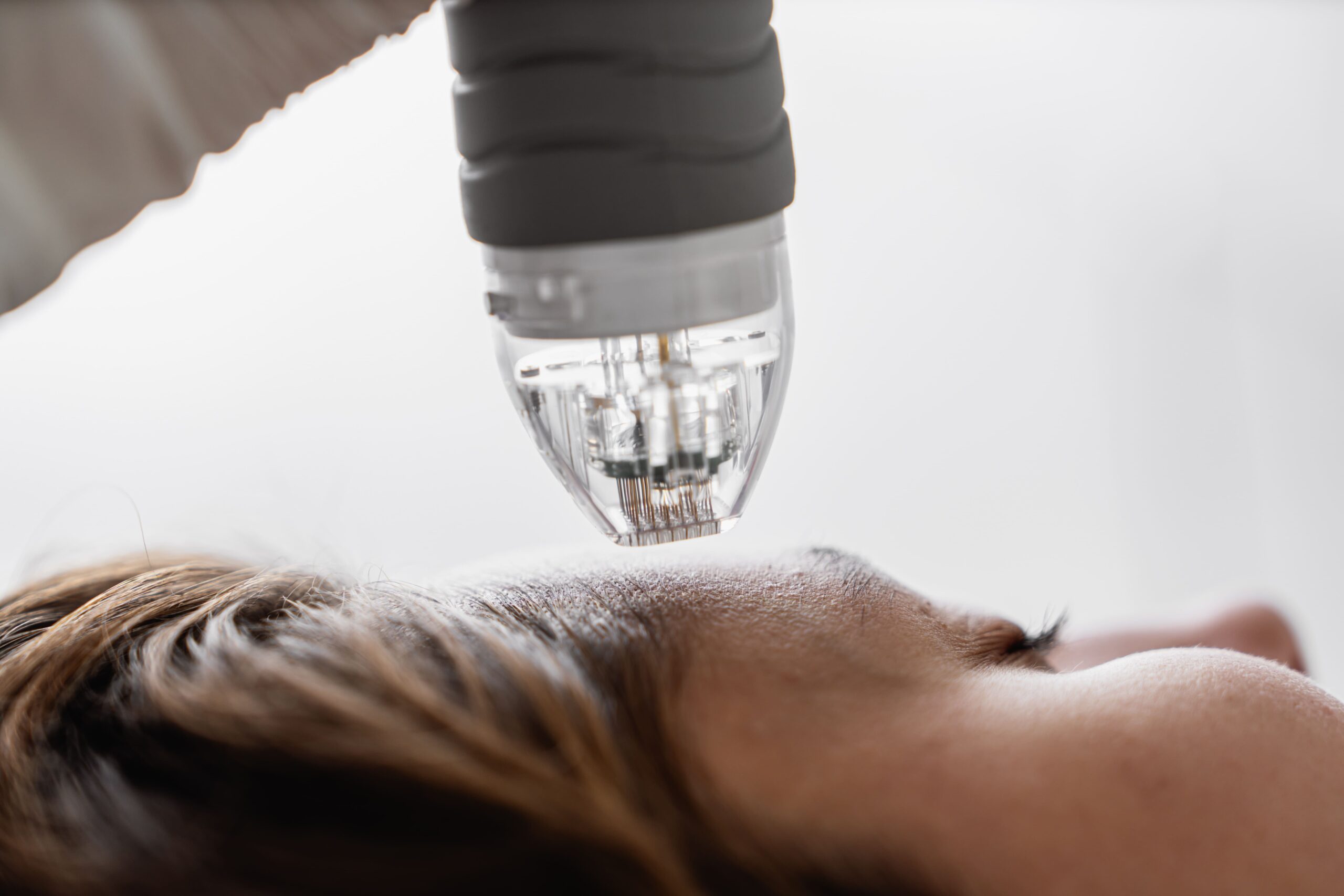 close up of microneedling treatment on person s fa 2026 03 19 10 39 37 utc 1 scaled